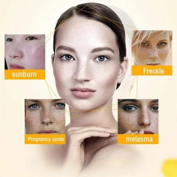 Zoo-Son (Original) Whitening Freckle Cream