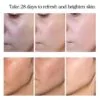 Whitening Freckle Cream, Acne Scar Removal Treatment, Pigmentation Removal, Remove Dark Spots