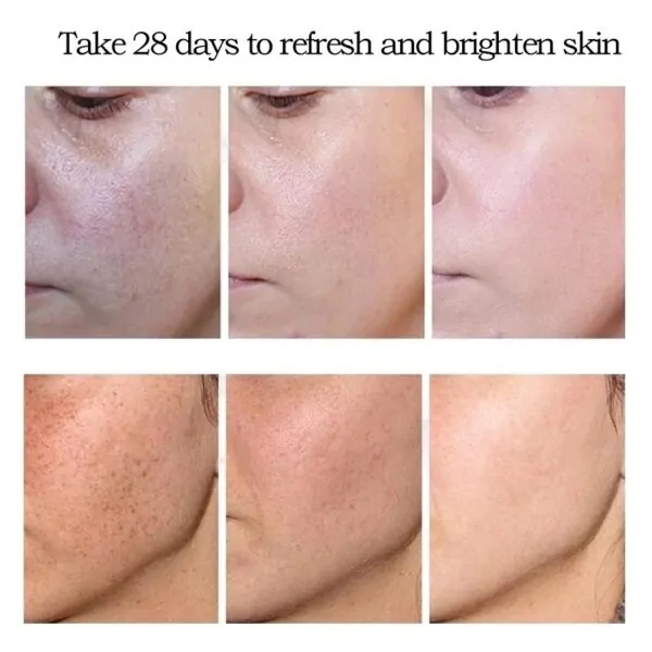 Whitening Freckle Cream, Acne Scar Removal Treatment, Pigmentation Removal, Remove Dark Spots