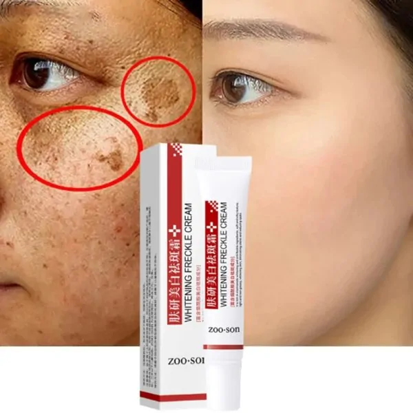 Whitening Freckle Cream, Acne Scar Removal Treatment, Pigmentation Removal, Remove Dark Spots