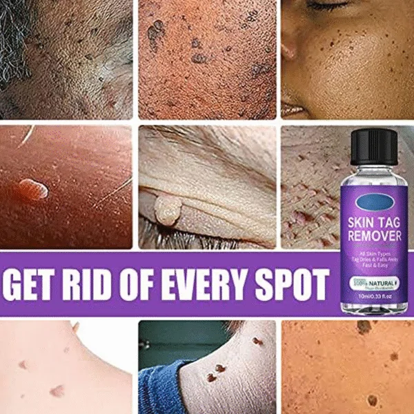 EELHOE Skin Tag Remover 10ml